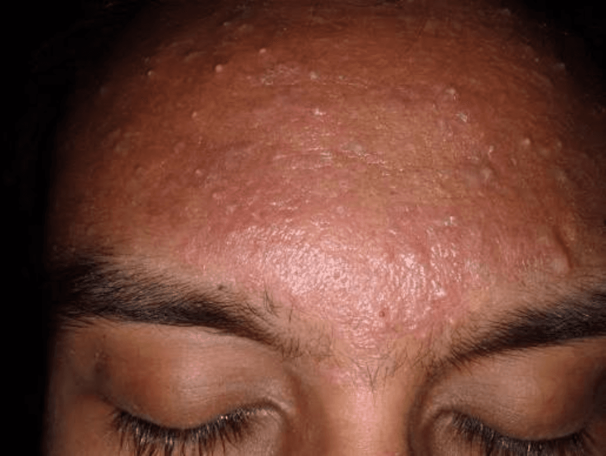 Pesquisa: 45% dos jovens usam TikTok como fonte para dúvidas sobre acne